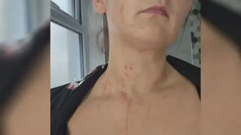 Claire from the mouth down - there are visible red injuries to her upper chest, neck and right cheek